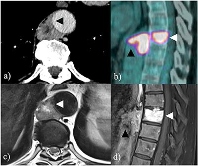 Multi-Step Combined Upfront Surgery for Locally Advanced Paravertebral Sarcoma: A Case Report